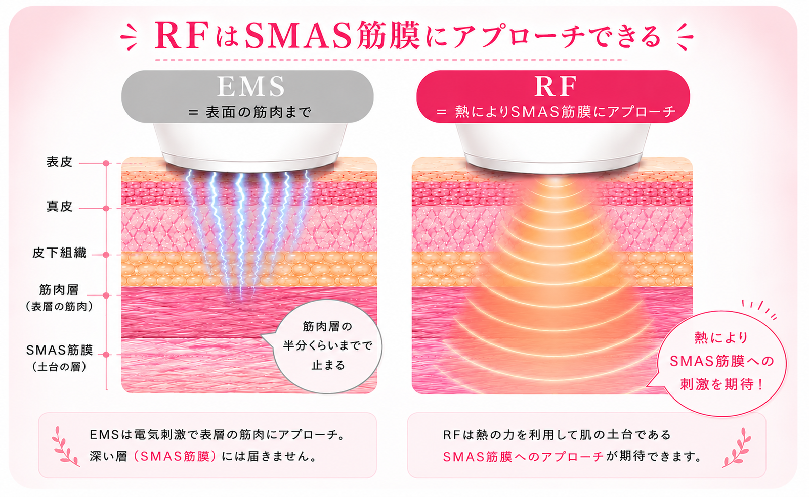 RFがSMAS筋膜にアプローチ